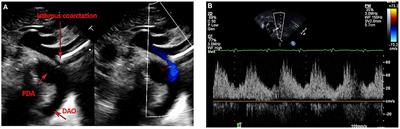 Isolated Coarctation of the Aorta: Current Concepts and Perspectives